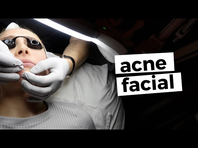 Esty Gets An Acne Facial (Extractions, High Frequency, Peel)