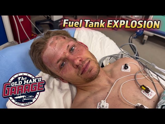 FUEL TANK EXPLOSION LEAVES BILLY HOSPITALIZED.