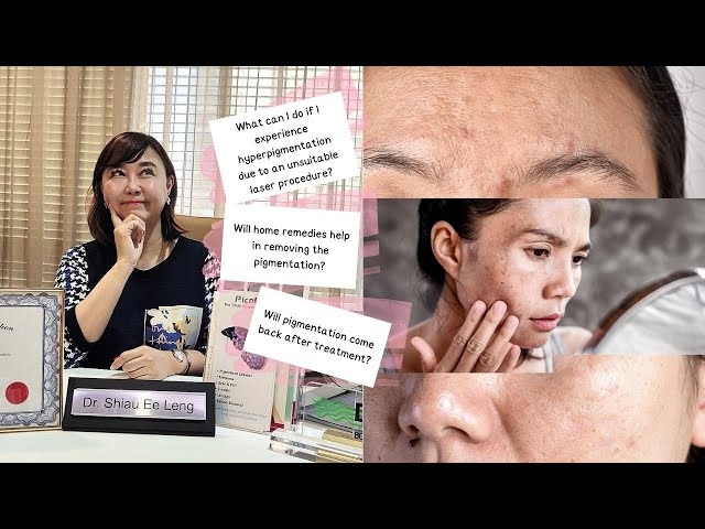 Unveiling the Unspoken Rules about Pigmentation Removal Methods on Face