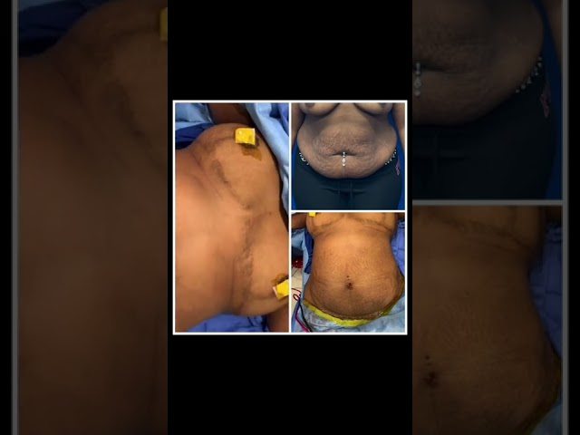 Arm lift + liposuction before and after photos dr jeneby