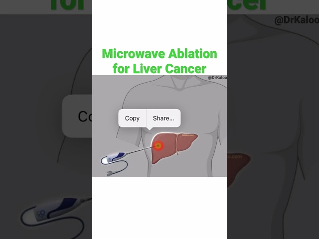 Microwave Ablation for Liver Cancer (HCC)