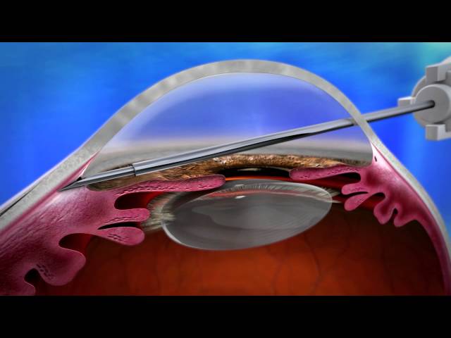 XEN Aquesy - Gel Stent -  The London Ophthalmology Centre