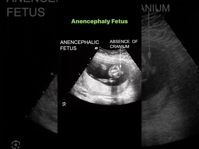 Anencephaly Fetus
