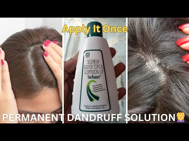 Dandruff को हमेशा के लिए कहे  GoodBye |Selsun Shampoo Honest Review #shampoo#haircare #tips#trending