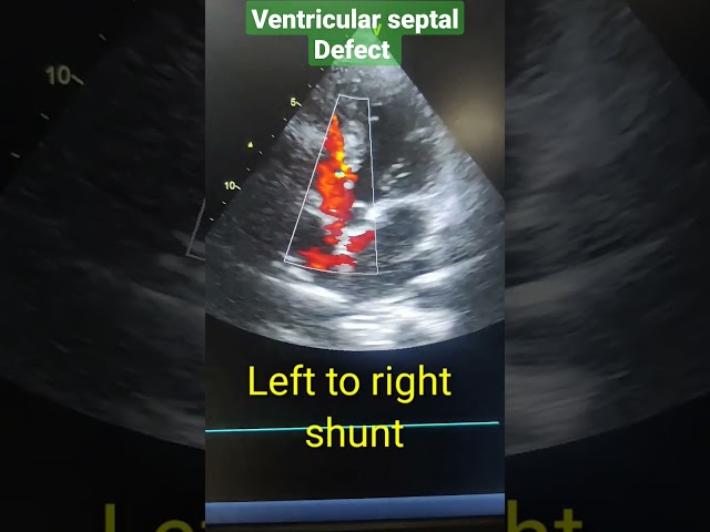 VSD (ventricular septal defect) in Echo, left to right shunt #youtubeshorts #shortsvideo #shorts