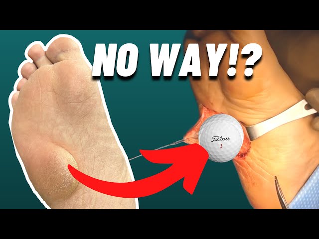 SURGEON REMOVES GOLF BALL SIZE MASS FROM FOOT!