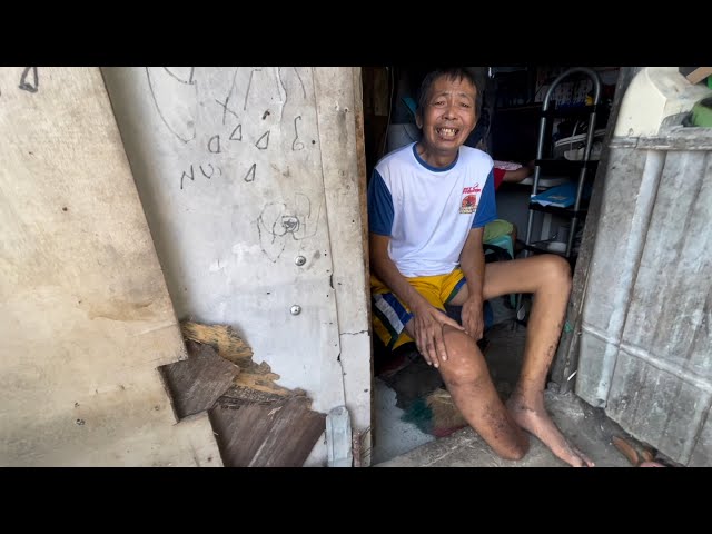 Helping Filipino man that lost his leg to diabetes ( Norman )