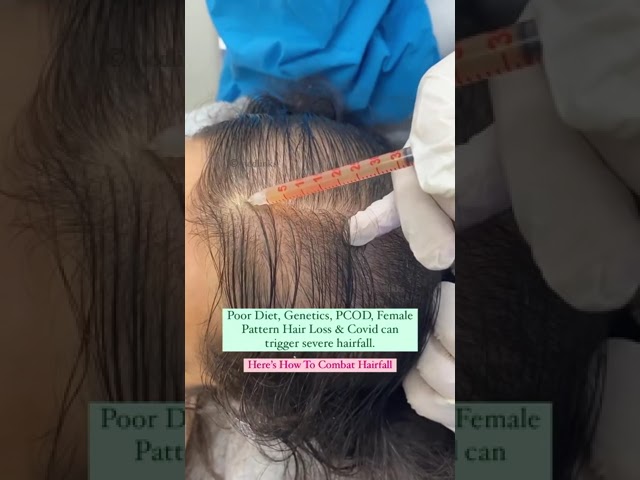 PRP - Best hair loss treatment for females #shorts