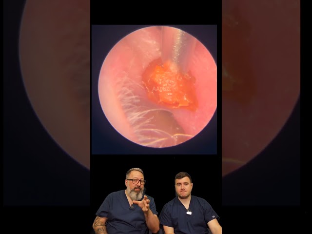 Quick Sticky Ear Wax Plug Removal! - EP987 #earcare