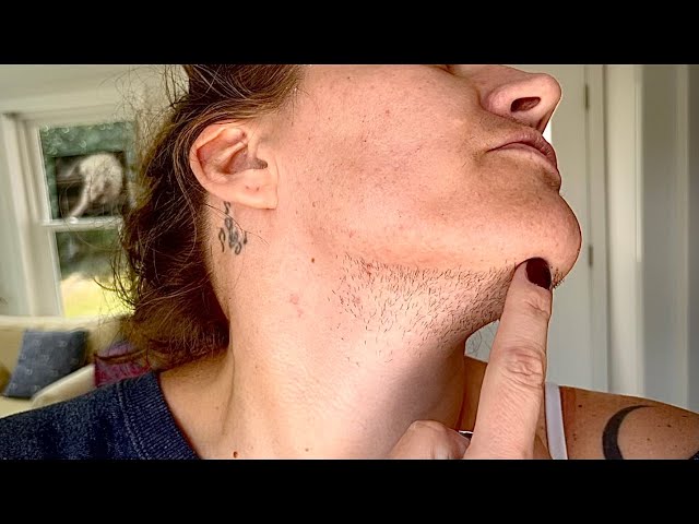 155 Hours: Overview of my ENTIRE Electrolysis permanent facial hair removal results, PCOS/Hirsutism