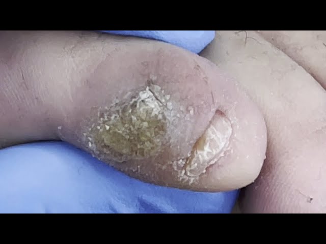 Plantar warts on little toes, hard and large, difficult to cut