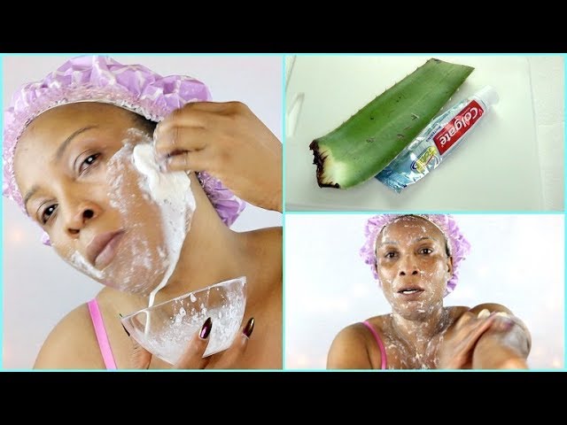YOU GOT TO SEE WHAT HAPPENED WHEN I APPLY ALOE VERA AND TOOTHPASTE ON MY  SKIN |Khichi Beauty
