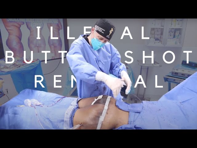 Removal of Hydrogel Injections from the Buttocks (Silicone Removal from the Butt)