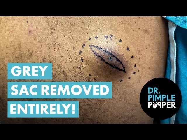 'Big SQUEEZE'   Dr Pimple Popper Removes Large Back Cyst, Grey Sac Removed Entirely but Deflated