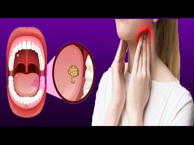 Swollen Cervical Lymph Nodes: Causes And Treatment