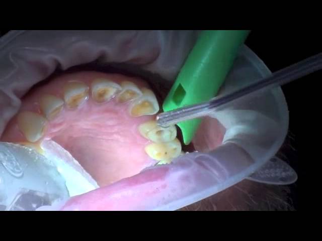 Laser Assisted Root Canal on Upper Bicuspid #12