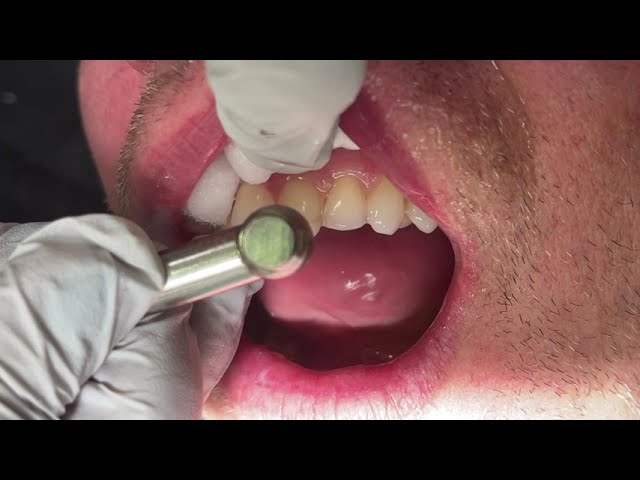 Houston Cosmetic Dentist...Minimal Prep Veneer procedure and how to make beautiful temporaries...