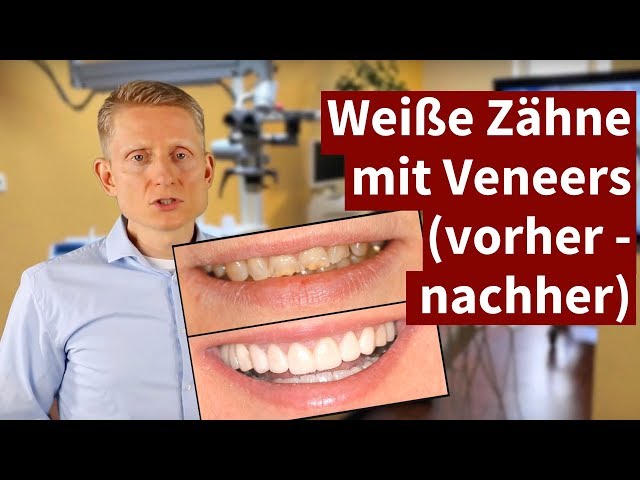 Weiße Zähne mit Veneers (vorher - nachher) 2021