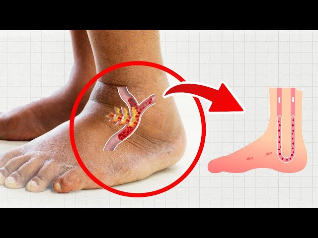 Eliminate Swelling in Feet and Legs.  Top Vitamins To Boost Legs and Foot Circulation Instantly! #1