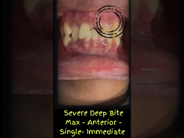 SEVERE DEEP BITE CASE! WHATS YOUR PLAN?? PATIENT WANTS TO REPLACE ONLY MISSING TOOTH?