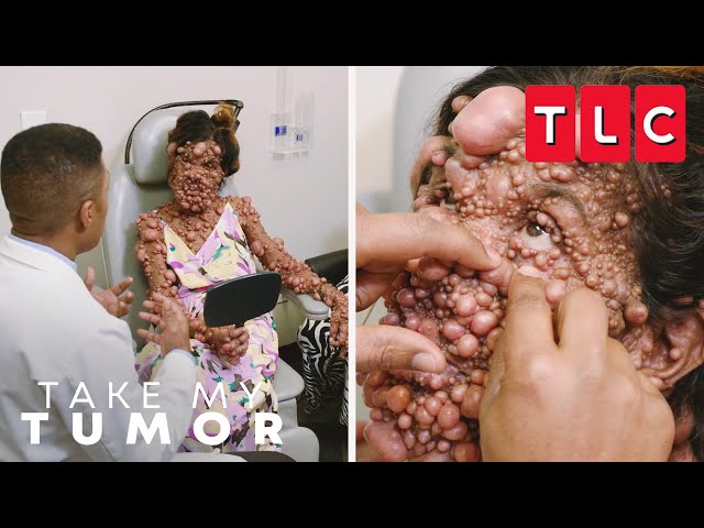 A One-Of-A-Kind Case of Neurofibromatosis | Take My Tumor | TLC