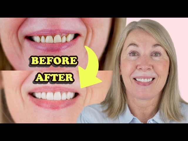 Smile Transformation: 8 Porcelain Veneers!