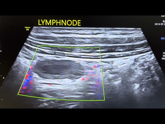 Lymphnode with internal necrotic changes