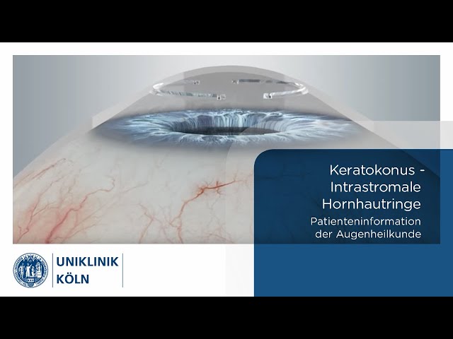 Keratokonus - Intrastromale Hornhautringe (Patienteninformation Augenklinik) | Uniklinik Köln
