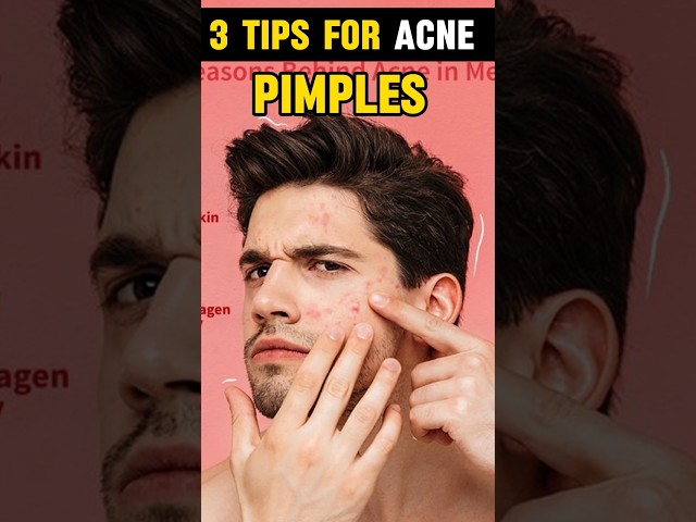 🔥3 Tips For Acne problem ✅ | men's fashion tips bangla#Shorts#shortsfeed#pimples