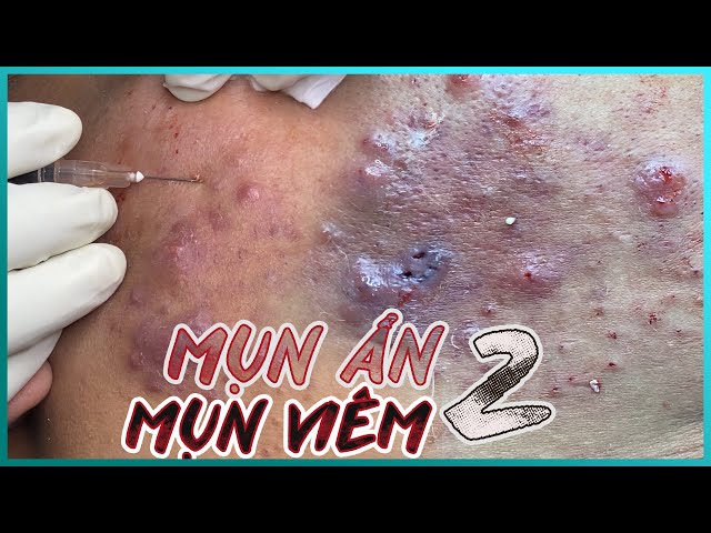 Big Cystic Acne Blackheads Extraction Blackheads & Milia, Whiteheads Removal Pimple Popping
