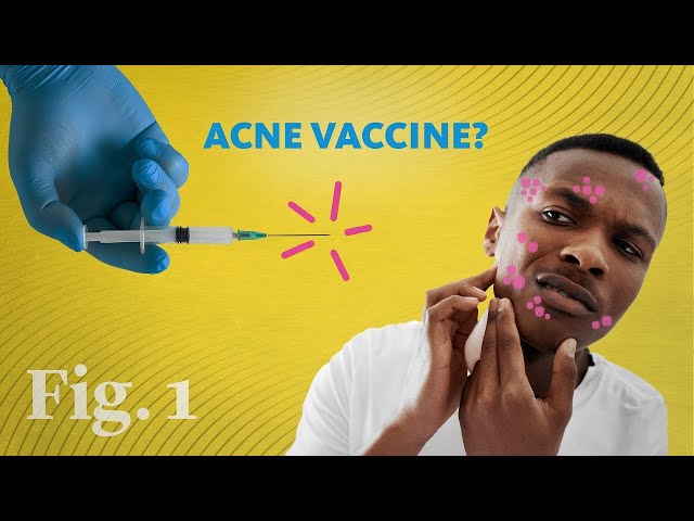 Get rid of acne...with a vaccine?