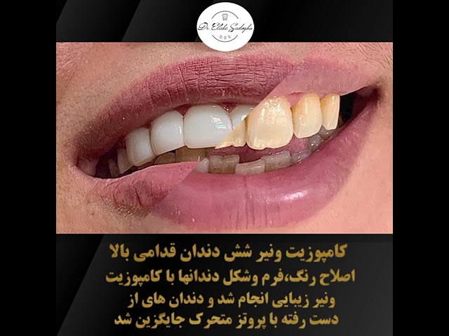 کامپوزیت ونیر دندان های قدامی _ بهترین دندانپزشک زیبایی در شمال تهران
