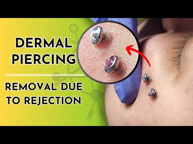 Dermal Piercings | Removal (Due to Rejection) 💎❌