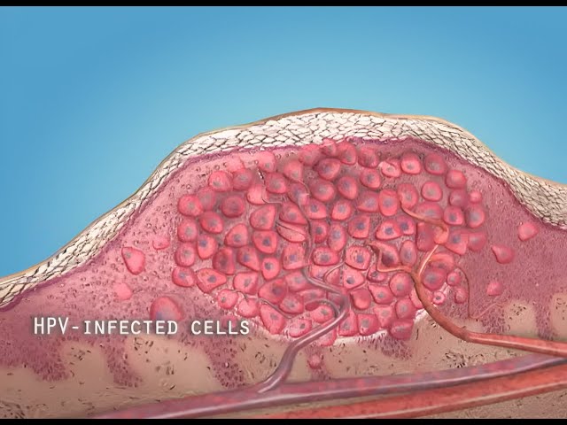 What are warts (HPV)? - 3D animation
