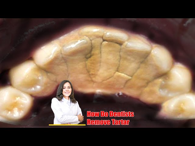 SCALING 45yo FEMALE Tartar Removal from teeth! Both front and back teeth are full of tartar