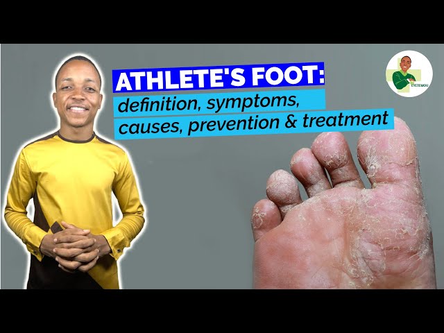 ATHLETE'S FOOT (Tinea pedis): definition, causes, symptoms, treatments & prevention (Dr Eyetemou)