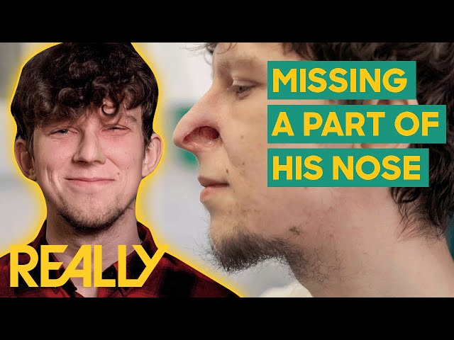 Young Man's New Nose Prosthetic Changes His Life! | The Face Doctors