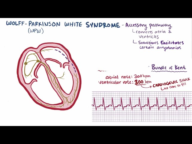 Wolff Parkinson White Syndrome | Osmosis