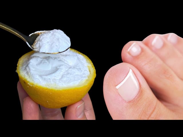 🔥 You will never have fungus on your nails again! 100% natural remedy for toenail fungus