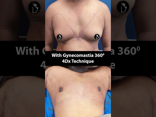Male Breast to Normal Chest | 360 Gynecomastia Surgery Before and After #ytshorts
