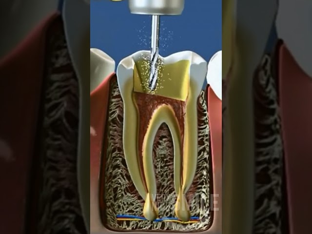Root canal #shorts