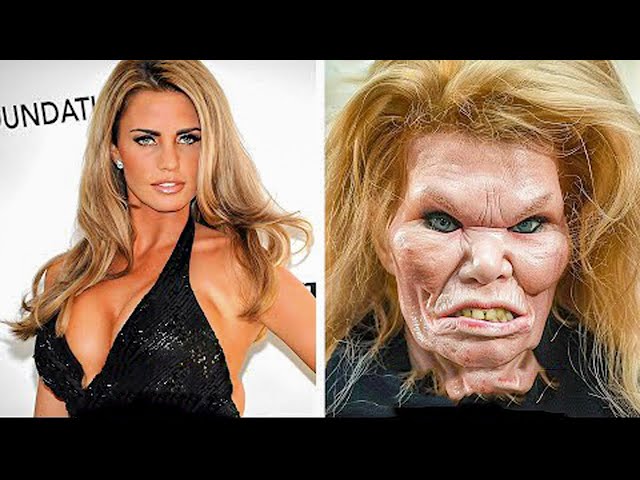 Before and After Plastic Surgery - Cosmetic Disasters of Hollywood Actors #9