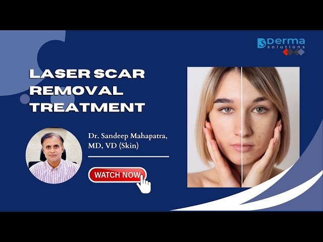Laser Scar Removal Treatment | CO2 laser Treatment | Acne Scar Removal in Bangalore | Derma Solution
