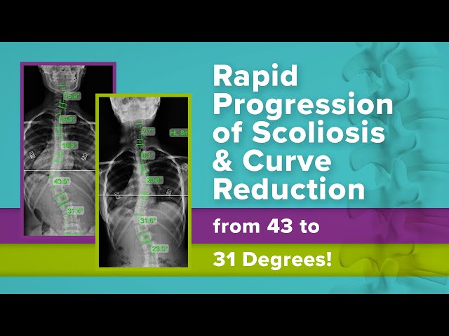 Rapid Progression of Scoliosis & Curve Reduction from 43 to 31 Degrees!