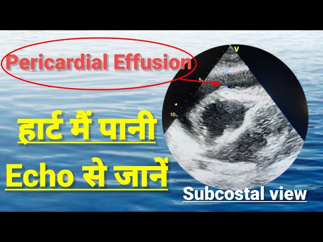Pericardial effusion, echocardiography of pericardial effusion,  हार्ट मैं पानी भर जाना