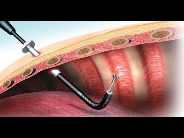 Thoracoscopy/VATS for esophageal cancer and benign lesions.