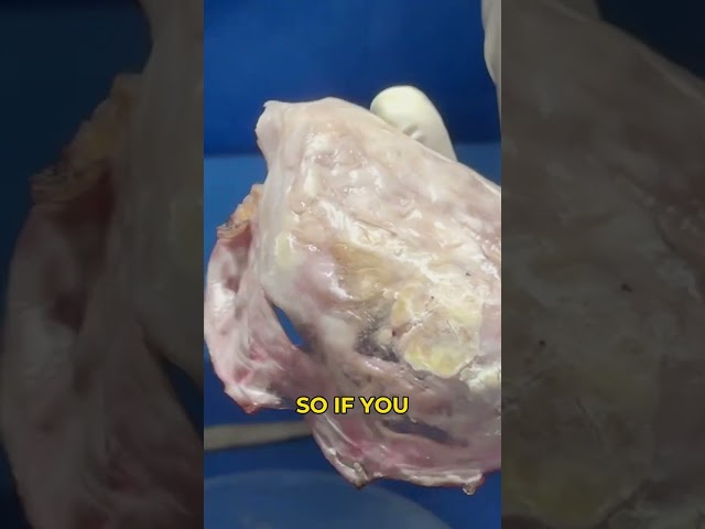 Shocking Calcifications Found During Breast Implant Removal