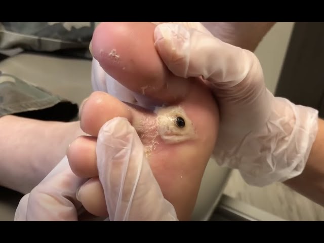 Foot Abscess Removal an explosion - Master Podology with Lexington Podiatry