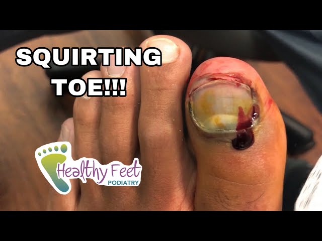 SQUIRTING TOE! ENTIRE NAIL REMOVED WITH SURPRISE UNDERNEATH!