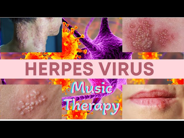 Herpes /  Music therapy /  Recommendations